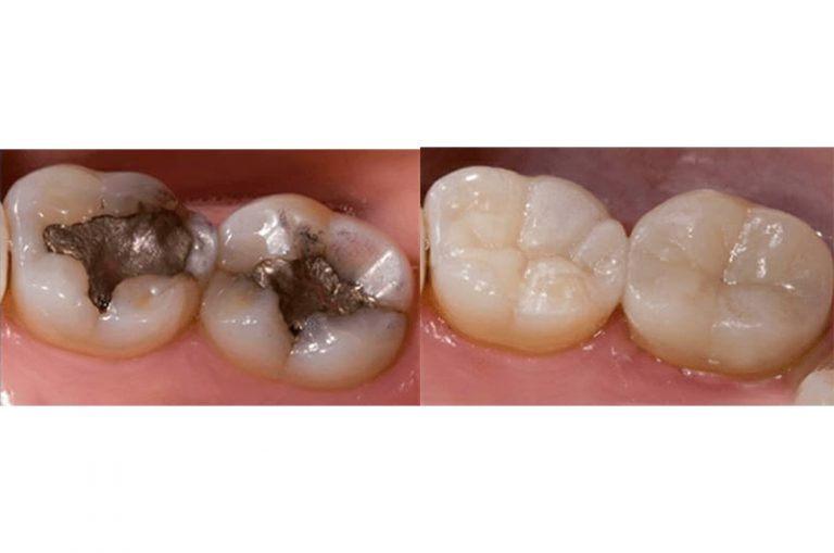 Composite resin fillings. Holistic Dentist Loondon